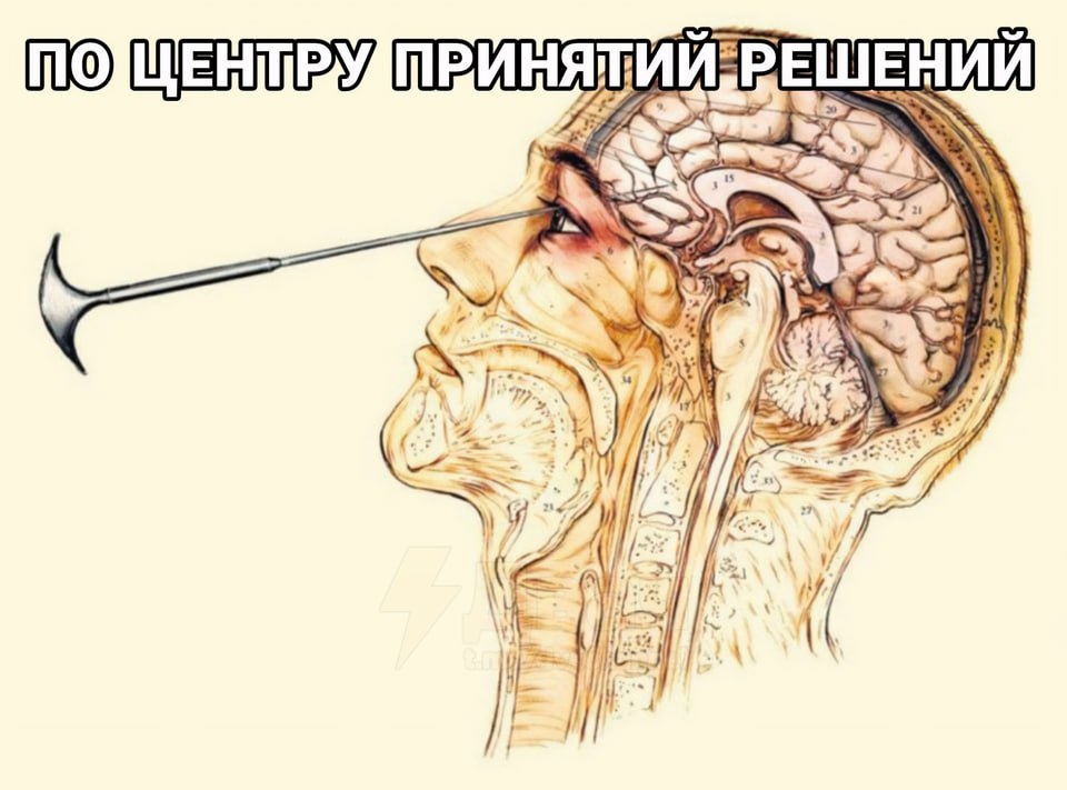 Мем: медицинская анатомическая иллюстрация разреза головы человека в профиль (мозг, носоглотка, шейный отдел позвоночника). Через ноздрю введён длинный хирургический инструмент (орбитокласт для лоботомии), достигающий лобной доли мозга. Сверху надпись: «ПО ЦЕНТРУ ПРИНЯТИЙ РЕШЕНИЙ».